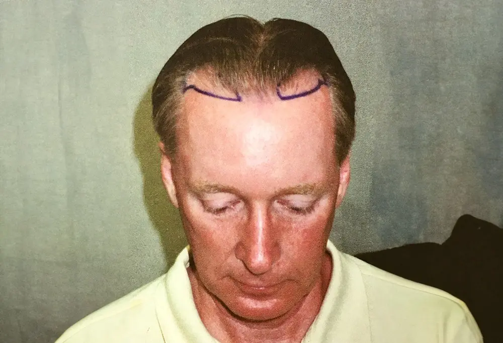 A man with two lines drawn on his head.