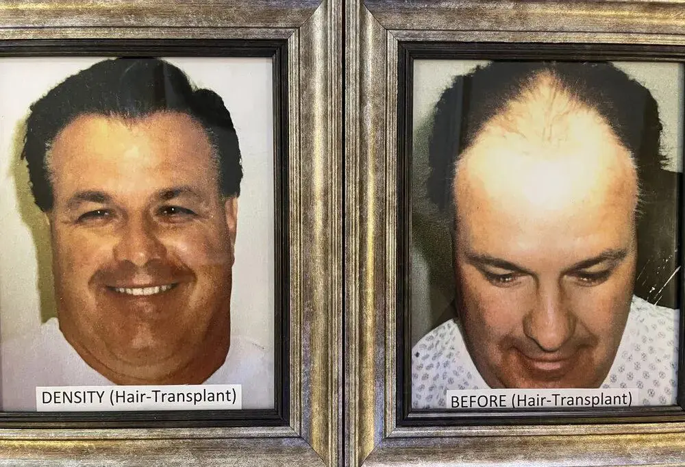 A man with a hair transplant and before and after.