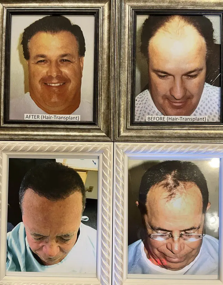 A man with different hair loss stages.