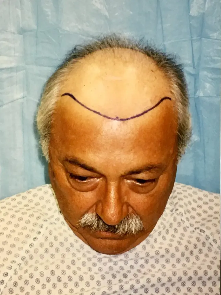 A man with an incision on his forehead.